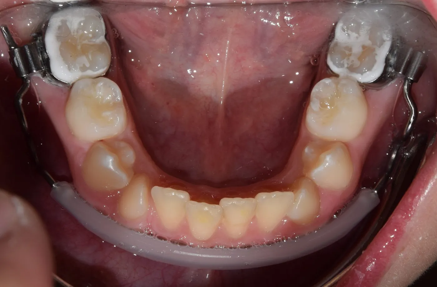 Lip-bumper – fogszabályozási fogalom illusztrációja